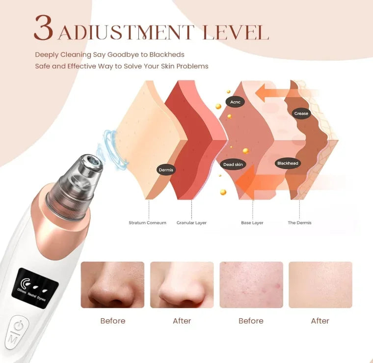 Blackhead Remover Pore Vacuum, Facial Pore Cleaner - 5 Suction Power, 5 Probes, USB Rechargeable
